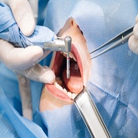 зъбни импланти цена - 14472 отстъпки