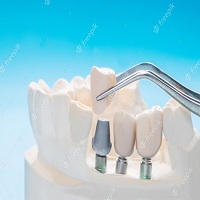 зъбни импланти цена - 22248 разновидности