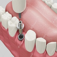 зъбни импланти цена - 57173 постижения