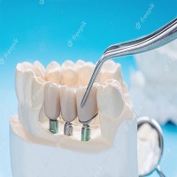 зъбни импланти цена - 72260 варианти