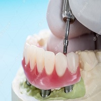 зъбни импланти цена - 12242 промоции